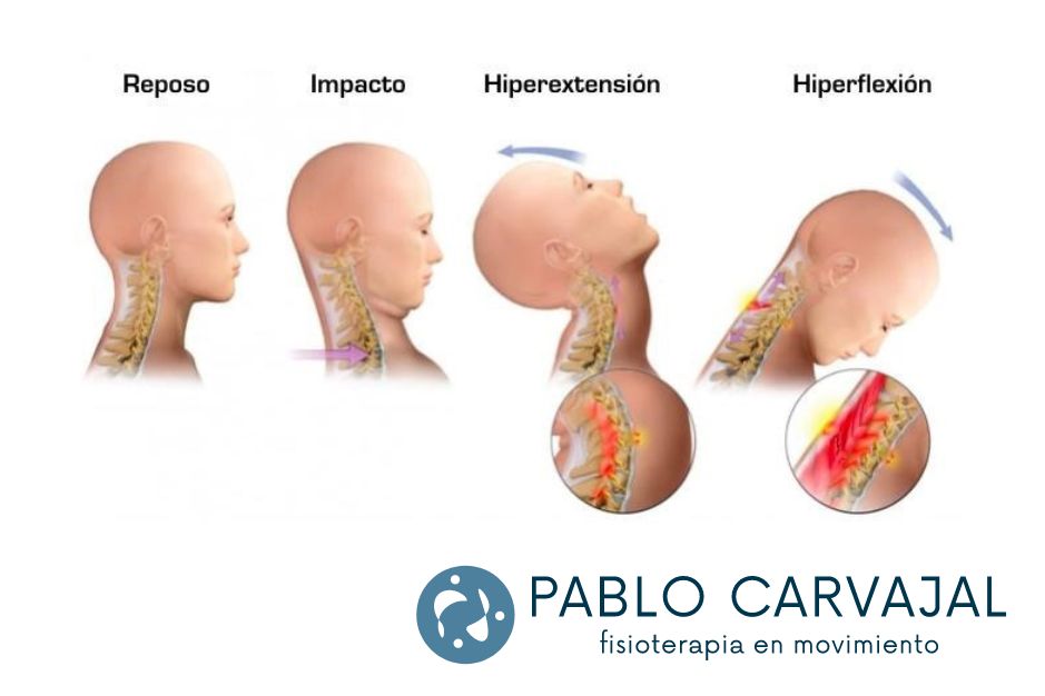 fisioterapia latigazo cervical jaen fisioterapeuta pablo carvajal